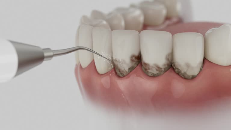 Reliable Wisdom Tooth Removal contractor in Bayview, CA by Smile Center Dentistry